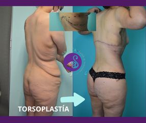 Torsoplastía - Dra. Jessica Ramírez Cadena