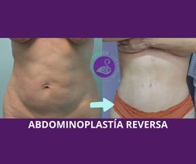 Abdominoplastía Reversa .Dra. Jessica Ramírez Cadena
