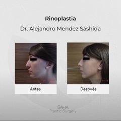 Rinoplastia - Dr. Alejandro Méndez Sashida