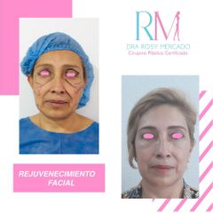 Antes y después de rejuvenecimiento facial - Dra. Rosy Mercado  