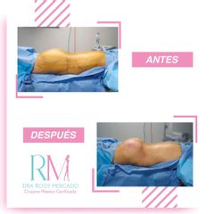 Antes y después de aumento de gluteos - Dra. Rosy Mercado  