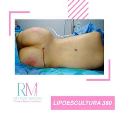 Postoperatorio Lipo 360 - Dra. Rosy Mercado 