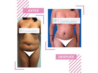 Antes y después de liposucción - Dra. Rosy Mercado
