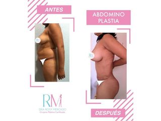 Antes y después de abdominoplastia - Dra. Rosy Mercado 