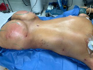 Gluteoplastia con grasa - Dra. Rosy Mercado