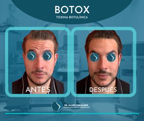 Toxina Botulínica - Dr. Ulises Caballero de la Peña
