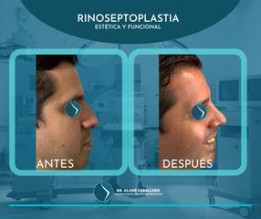 Rinoseptoplastia - Dr. Ulises Caballero de la Peña