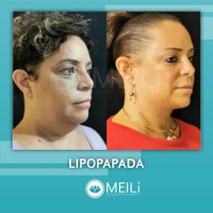 Lipopapada - MEILI - Rejuvenecimeinto