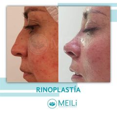 Rinoplastia - MEILi -  Rejuvenecimiento