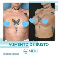 Aumento De Busto - MEILi - Rejuvenecimiento