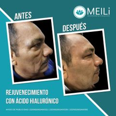 Armonización Facial - MEILi - Rejuvenecimiento