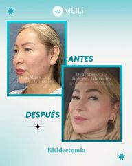 Ritidectomia - MEILi Rejuvenecimiento