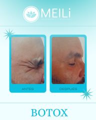 Toxina Botulínica - MEILi Rejuvenecimiento