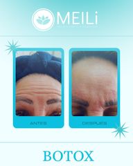 Toxina Botulínica - MEILi Rejuvenecimiento