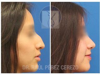 Antes y después de Rinoplastia estética y funcional.