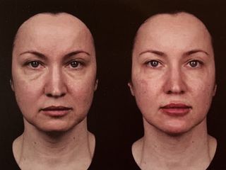 Antes y después de Aplicación de rellenos faciales