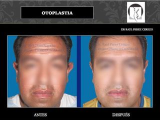 Antes y después de Otoplastia