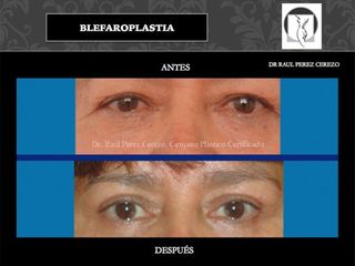 Antes y después de Blefaroplastia