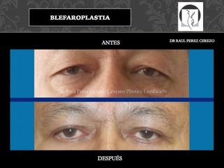 Antes y después de Blefaroplastia