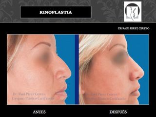 Antes y después de Rinoplastia