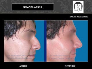 Antes y después de Rinoplastia