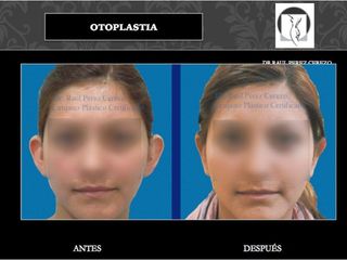 Antes y después de Otoplastia