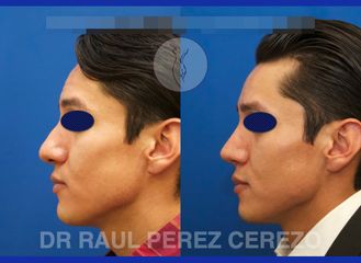 Antes y después de Rinoplastia