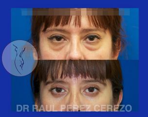 Antes y después de Blefaroplastia