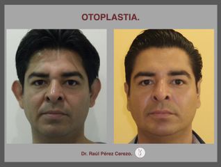 Antes y después de Otoplastia 