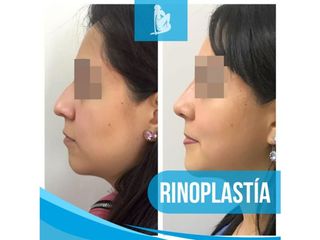 Antes y después de Rinoplastia