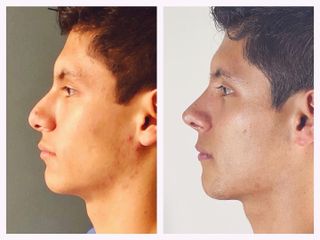 Rinoplastia - Dr. Christian Augusto Morales Orozco