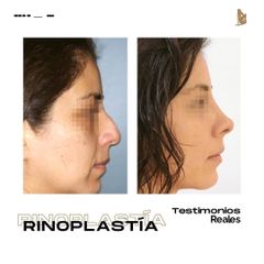 Rinoplastia - Dr. Christian Augusto Morales Orozco