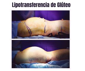 Lipotransferencia de Glúteo - Dr. Christian Augusto Morales Orozco