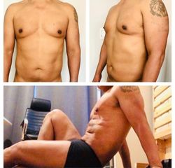 Lipo HD en hombre