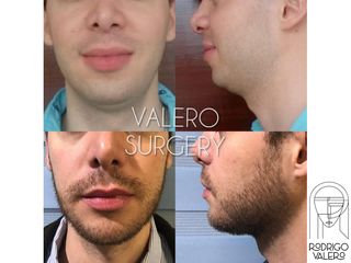 Cirugía de papada - Dr. Rodrigo Valero Jarillo