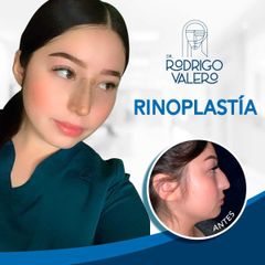 Rinoplastia - Dr. Rodrigo Valero Jarillo