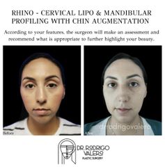 Cirugía facial - Dr. Rodrigo Valero Jarillo
