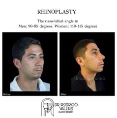 Rinoplastia - Dr. Rodrigo Valero Jarillo