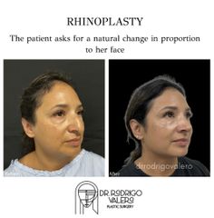 Rinoplastia - Dr. Rodrigo Valero Jarillo