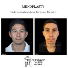 Rinoplastia - Dr. Rodrigo Valero Jarillo
