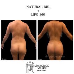 Liposucción - Dr. Rodrigo Valero Jarillo