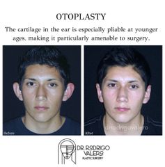 Otoplastia - Dr. Rodrigo Valero Jarillo