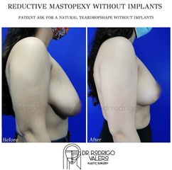 Reducción de mamas - Dr. Rodrigo Valero Jarillo