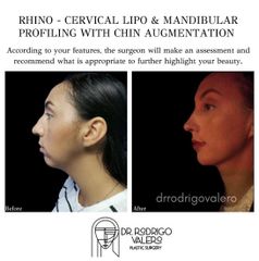 Cirugía facial - Dr. Rodrigo Valero Jarillo