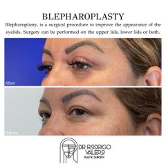 Blefaroplastia- Dr Rodrigo Valero