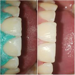 Implantes dentales - C.D. Gustavo Gaitán Ortiz