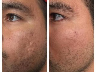 Antes y después de eliminación de cicatrices de acné