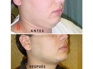 Antes y después de Cirugía de papada