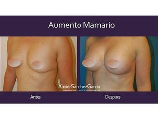 Antes y después de Aumento de busto