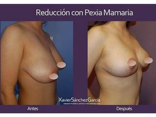 Antes y después de Mastopexia